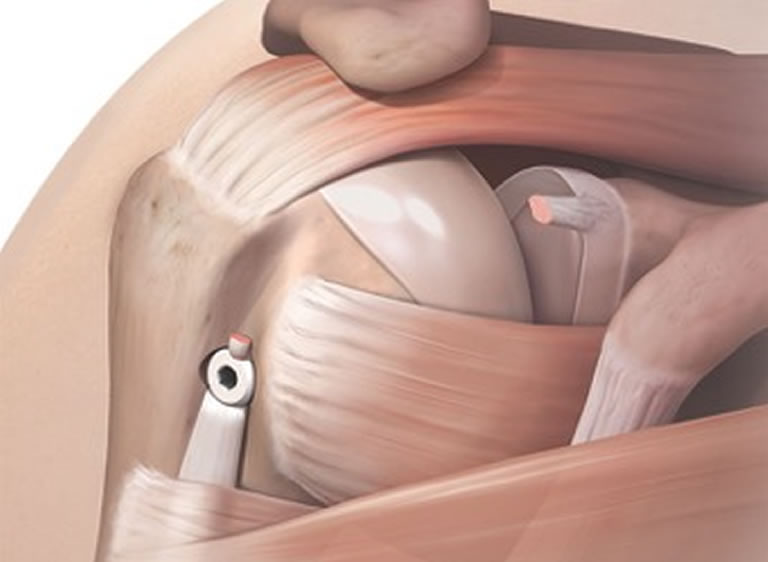 Biceps Tendon Repairs Diagram