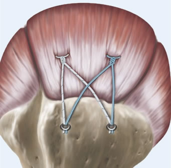 Rotator Cuff Repairs Diagram