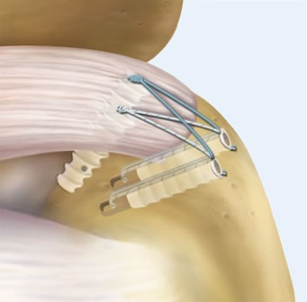 Rotator Cuff Repairs Diagram